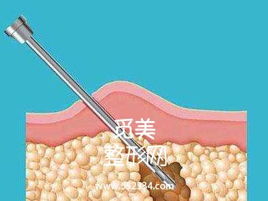 深圳博美王红玮吸脂的技术技术怎么样?案例图分享