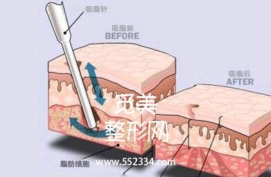 深圳博美王红玮吸脂的技术技术怎么样?案例图分享
