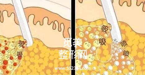 深圳博美王红玮吸脂的技术技术怎么样?案例图分享