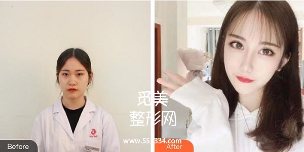 山东省立医院整形科薛峰隆鼻案例图,价格表分享·我的鼻子鼻子塌了,不是立体的。
