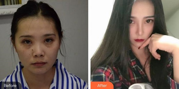 武汉同济医院整形科隆鼻真实案例图.价格表分享·我的鼻子从小就不是特别突出,山根也不高。