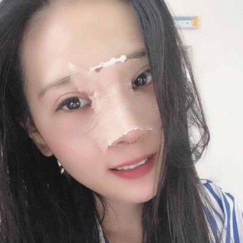 武汉同济医院整形科隆鼻真实案例图.价格表分享·我的鼻子从小就不是特别突出,山根也不高。