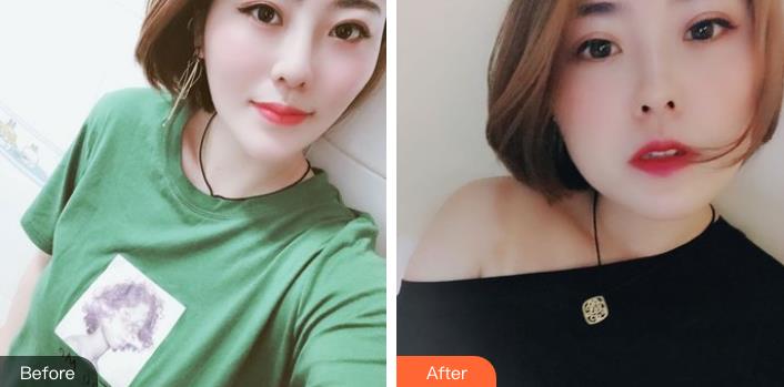 临沂沂水中心医院整形美容科去狐臭怎么样?附价格表及经历分享