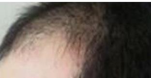 昆明韩辰植发整形案例图分享~不知道从什么时候开始，我的头顶就开始脱发，我是一个三十岁的男生