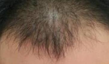 昆明韩辰植发整形案例图分享~不知道从什么时候开始，我的头顶就开始脱发，我是一个三十岁的男生
