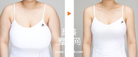 大连新华医院整形科乳房缩小 价格表/巨乳缩小案例图公开分享!