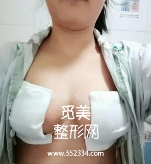 大连新华医院整形科乳房缩小 价格表/巨乳缩小案例图公开分享！