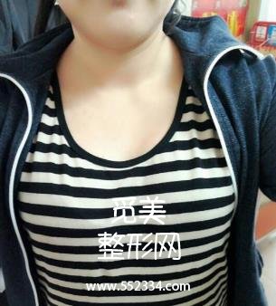 大连新华医院整形科乳房缩小 价格表/巨乳缩小案例图公开分享!