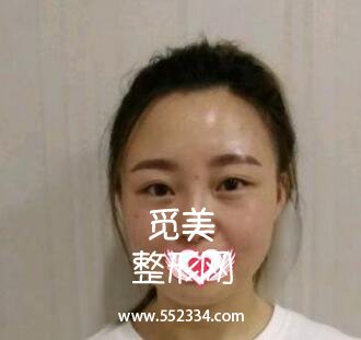 硅胶隆鼻+垫鼻尖改善天生的塌鼻子,上海九院整形科隆鼻案例图