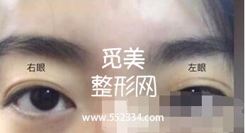 之前做过一次双眼皮,但是比较失败,比较浅,这次是严格来说是修复辣。北京八大处双眼皮修复案例图分享