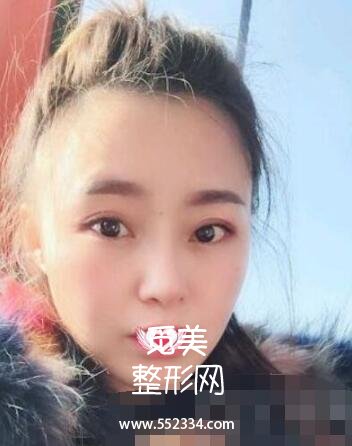 硅胶隆鼻+垫鼻尖改善天生的塌鼻子,上海九院整形科隆鼻案例图