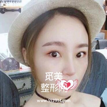 硅胶隆鼻+垫鼻尖改善天生的塌鼻子,上海九院整形科隆鼻案例图