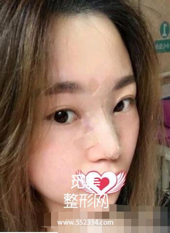硅胶隆鼻+垫鼻尖改善天生的塌鼻子,上海九院整形科隆鼻案例图