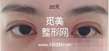 之前做过一次双眼皮,但是比较失败,比较浅,这次是严格来说是修复辣。北京八大处双眼皮修复案例图分享