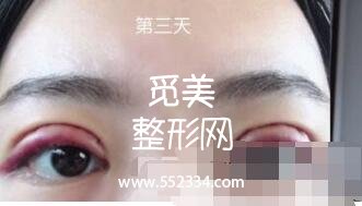 之前做过一次双眼皮,但是比较失败,比较浅,这次是严格来说是修复辣。北京八大处双眼皮修复案例图分享