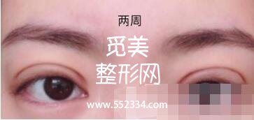 之前做过一次双眼皮，但是比较失败，比较浅，这次是严格来说是修复辣。北京八大处双眼皮修复案例图分享