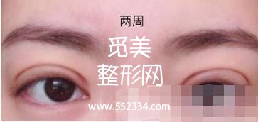 之前做过一次双眼皮,但是比较失败,比较浅,这次是严格来说是修复辣。北京八大处双眼皮修复案例图分享
