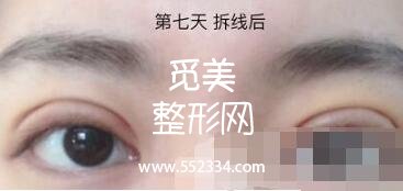 之前做过一次双眼皮,但是比较失败,比较浅,这次是严格来说是修复辣。北京八大处双眼皮修复案例图分享