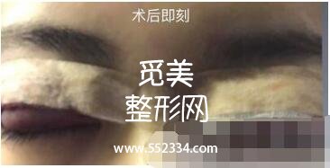 之前做过一次双眼皮,但是比较失败,比较浅,这次是严格来说是修复辣。北京八大处双眼皮修复案例图分享