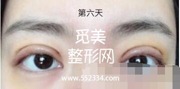 之前做过一次双眼皮，但是比较失败，比较浅，这次是严格来说是修复辣。北京八大处双眼皮修复案例图分享