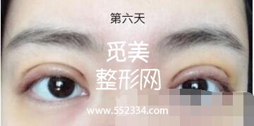 之前做过一次双眼皮,但是比较失败,比较浅,这次是严格来说是修复辣。北京八大处双眼皮修复案例图分享