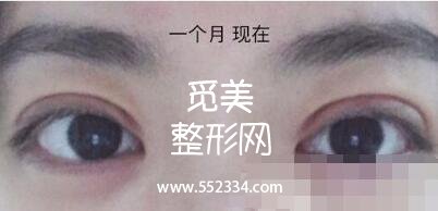 之前做过一次双眼皮,但是比较失败,比较浅,这次是严格来说是修复辣。北京八大处双眼皮修复案例图分享