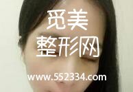 青岛诺美德医学美容门诊部张玉涛双眼皮手术 技术自然宛若天生