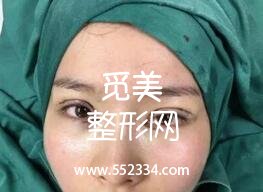 青岛诺美德医学美容门诊部张玉涛双眼皮手术 技术自然宛若天生