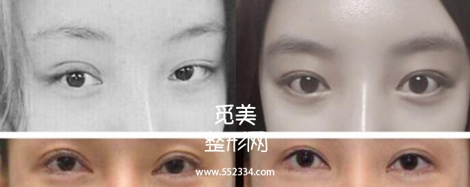 黑龙江大庆超龙做双眼皮修复怎么样？多少钱？