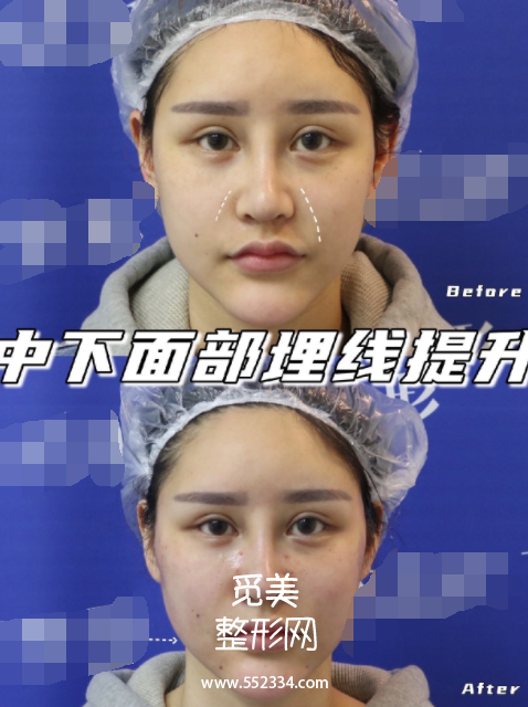 北京*案例,为了去法令纹做中下面部埋线提升