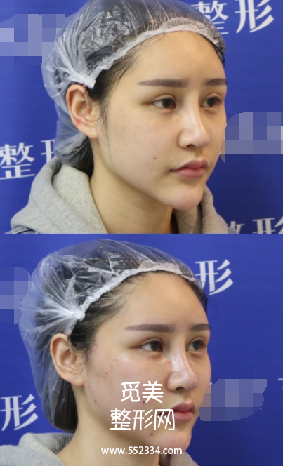 北京*案例,为了去法令纹做中下面部埋线提升