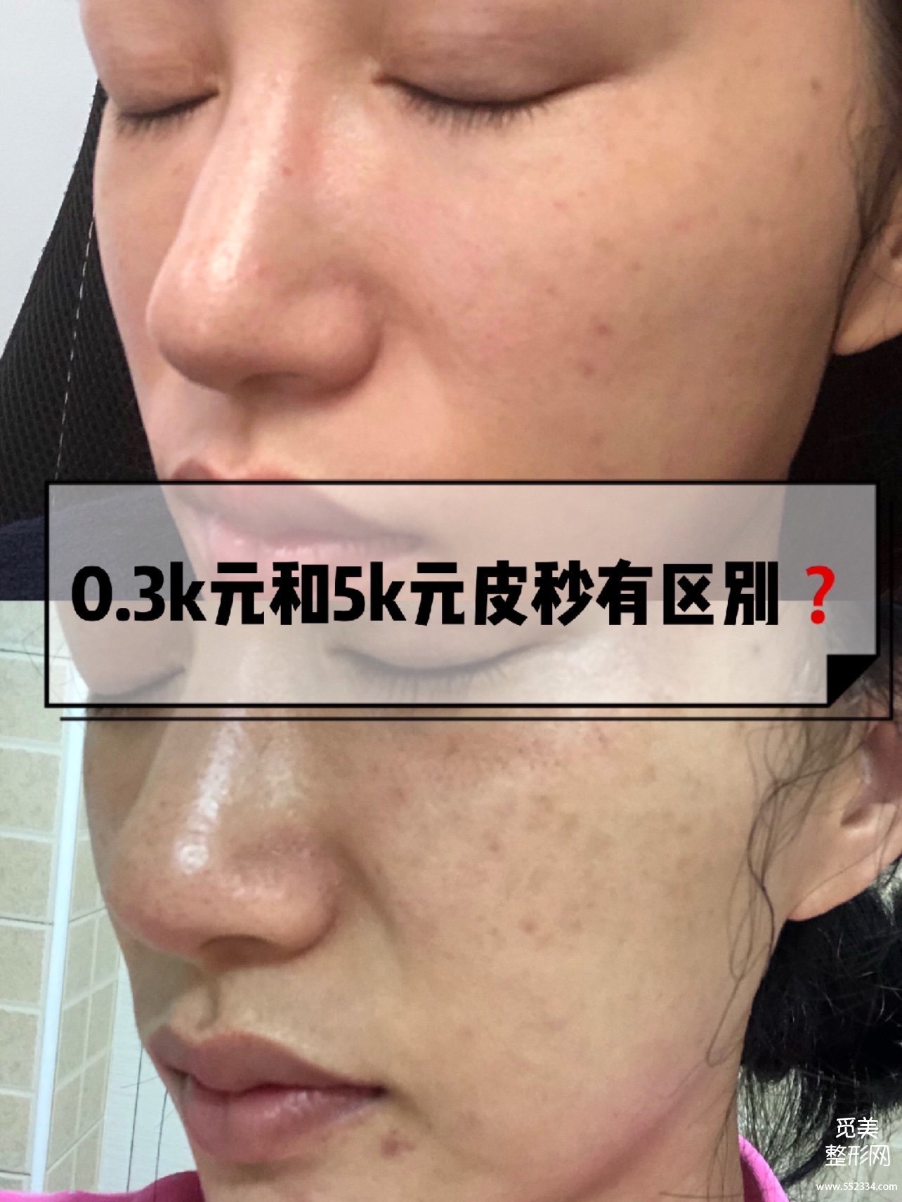 *祛斑价格揭秘：3百块和9千块的超*有区别吗？