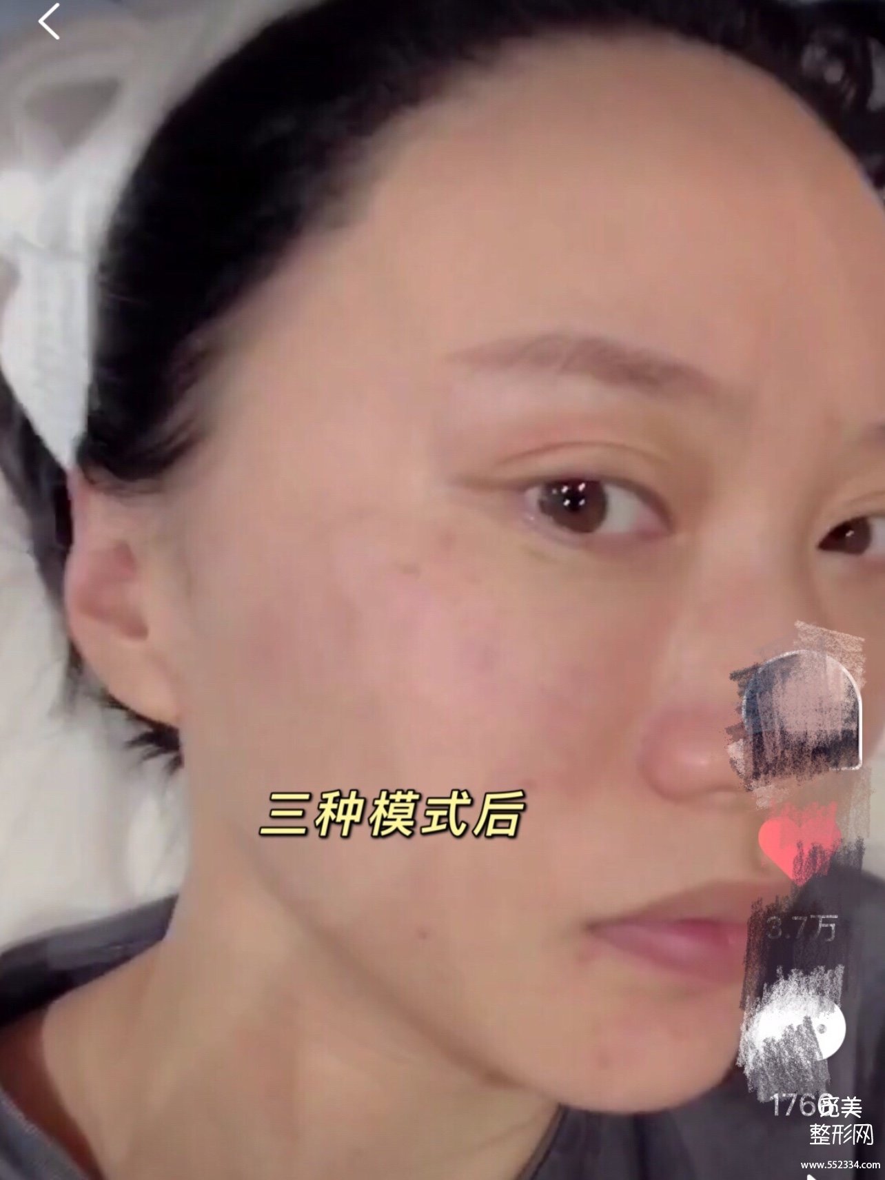 *祛斑价格揭秘:3百块和9千块的超*有区别吗?