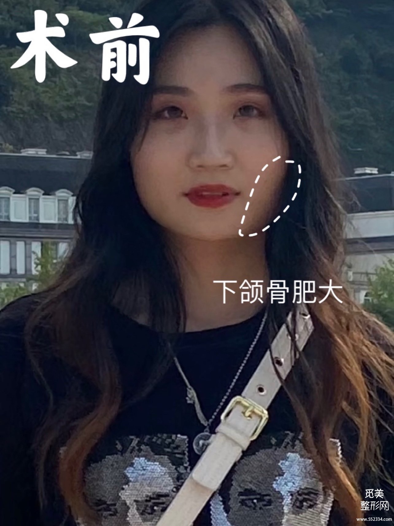花5w做的广州下颌角磨骨,国字脸变小脸,真香!