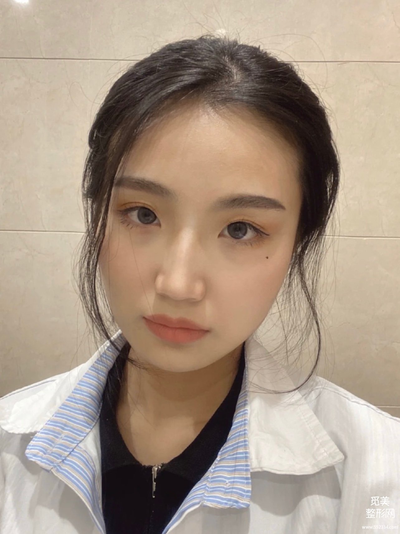 花5w做的广州下颌角磨骨,国字脸变小脸,真香!