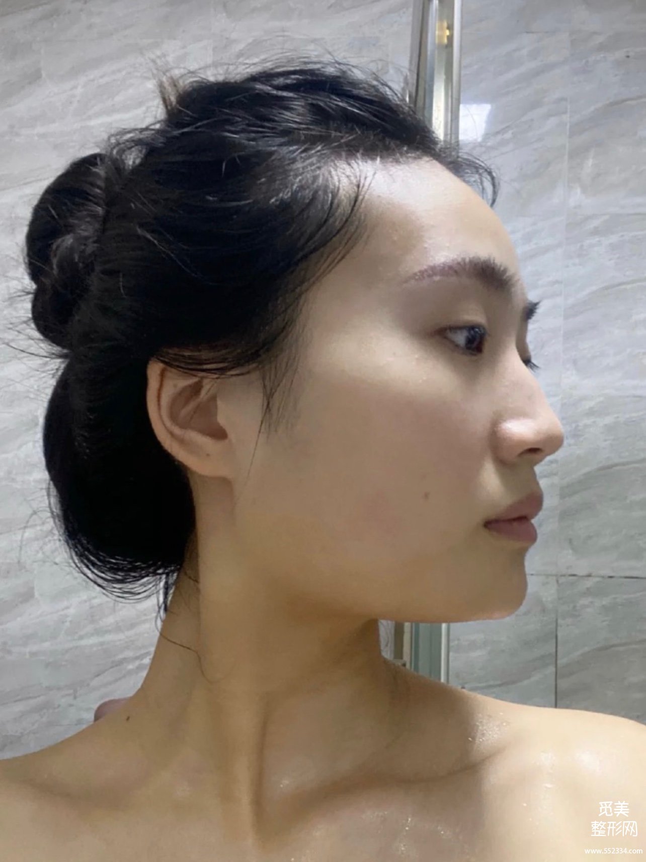 花5w做的广州下颌角磨骨,国字脸变小脸,真香!