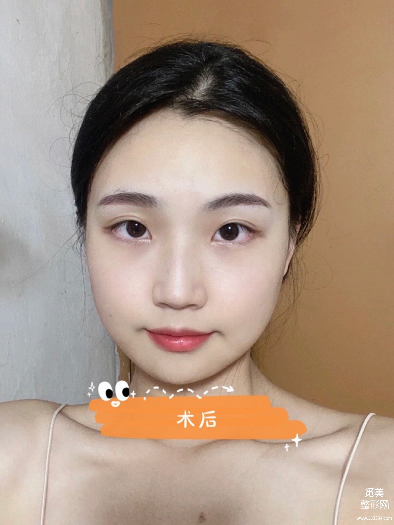 花5w做的广州下颌角磨骨,国字脸变小脸,真香!