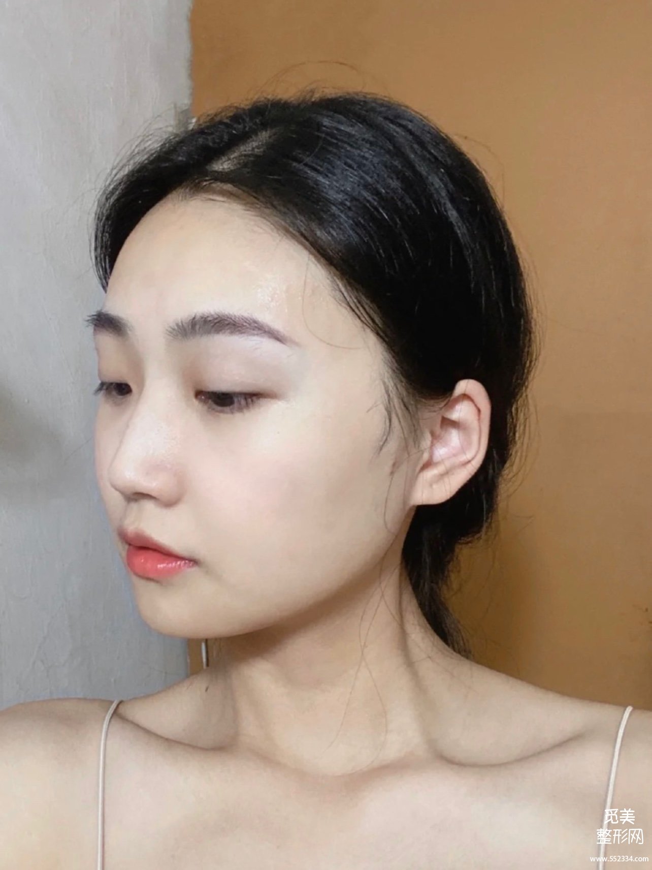花5w做的广州下颌角磨骨,国字脸变小脸,真香!