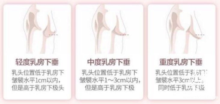 长沙做乳房下垂矫正多少钱?长沙雅美肖征刚技术好吗?