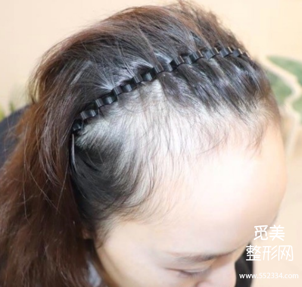 贵阳植发案例 | 发际线太高,种植了2900个单位