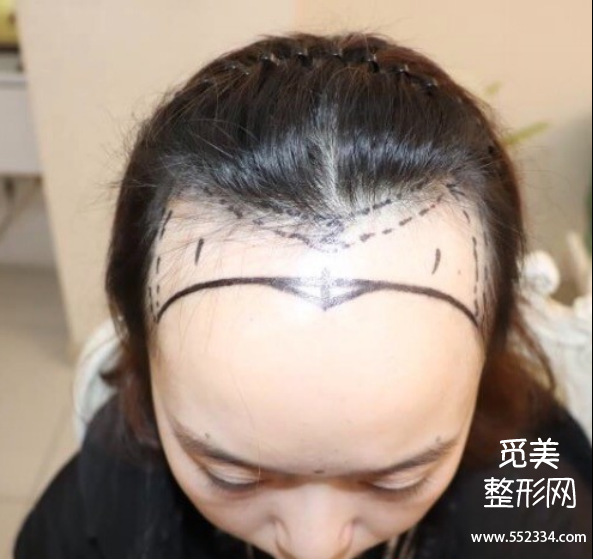 贵阳植发案例 | 发际线太高,种植了2900个单位