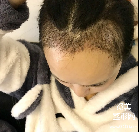 贵阳植发案例 | 发际线太高,种植了2900个单位