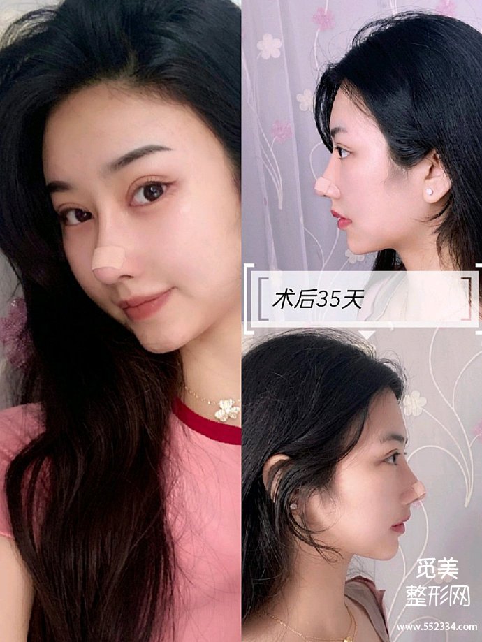 北京煤炭总医院王英勇隆鼻怎么样?鼻修复多少钱?