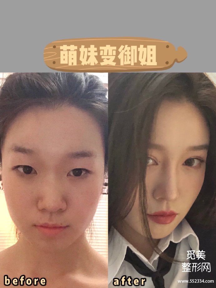 杭州美莱李波做鼻子真的很好吗?隆鼻案例有吗?