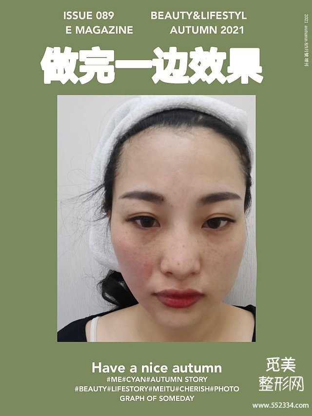 重庆热拉提案例|面部松弛下垂做小热玛吉痛感完全可以忍受!
