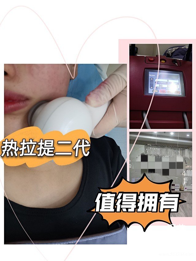 重庆热拉提案例|面部松弛下垂做小热玛吉痛感完全可以忍受!