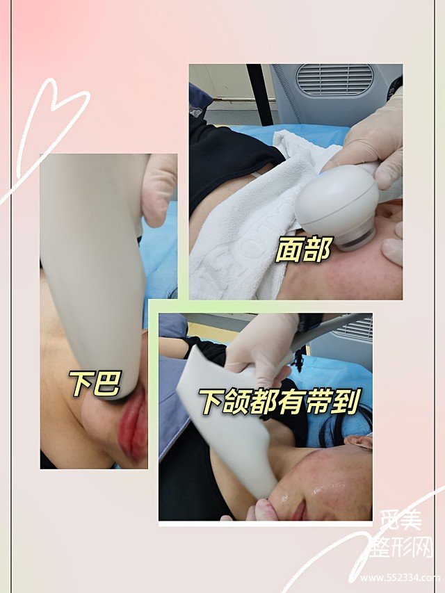 重庆热拉提案例|面部松弛下垂做小热玛吉痛感完全可以忍受！