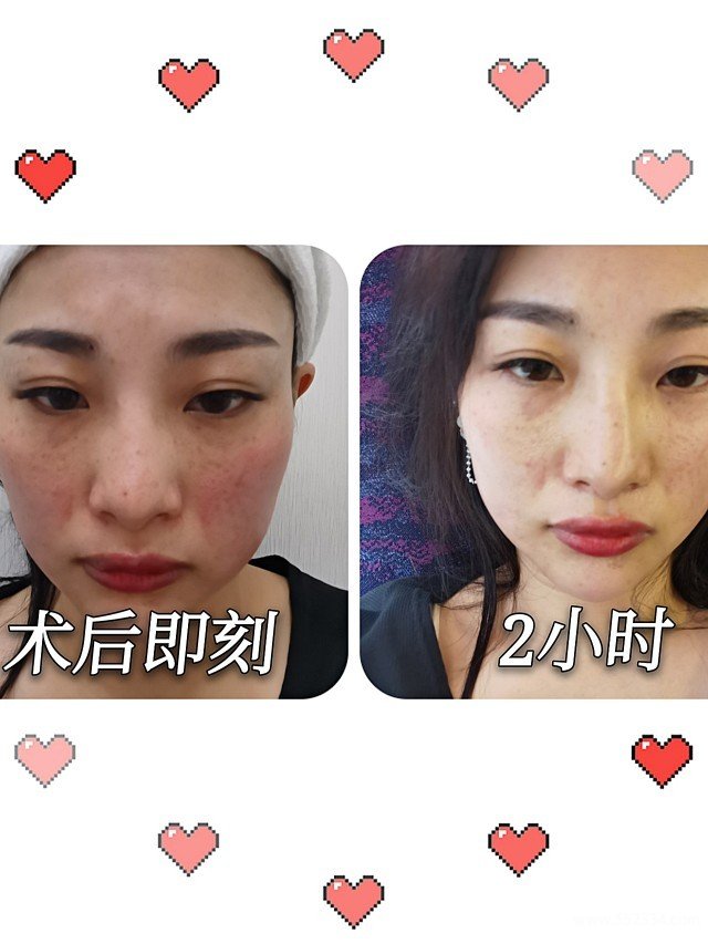 重庆热拉提案例|面部松弛下垂做小热玛吉痛感完全可以忍受!