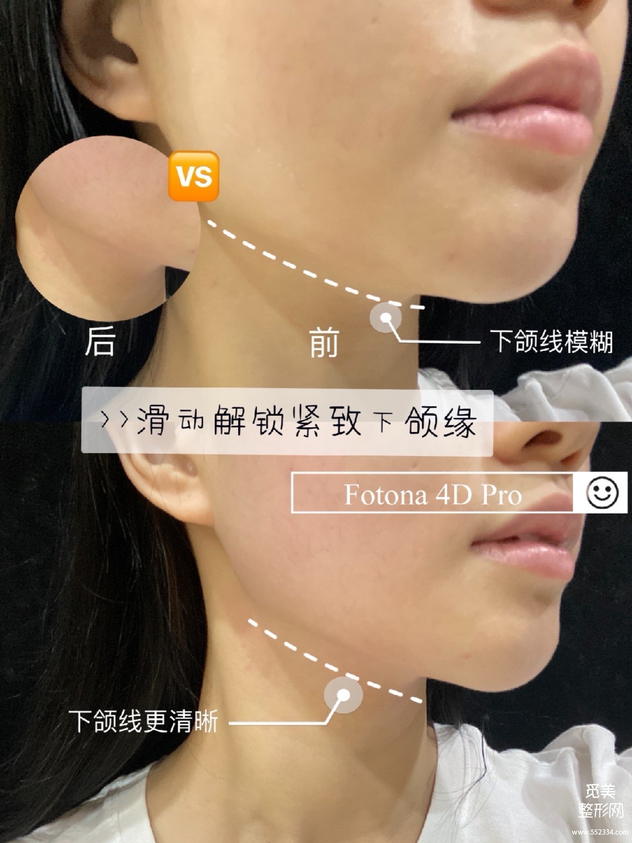 fotona 4d和热玛吉有区别吗?Fotona 4D Pro有没有副作用?案例解析