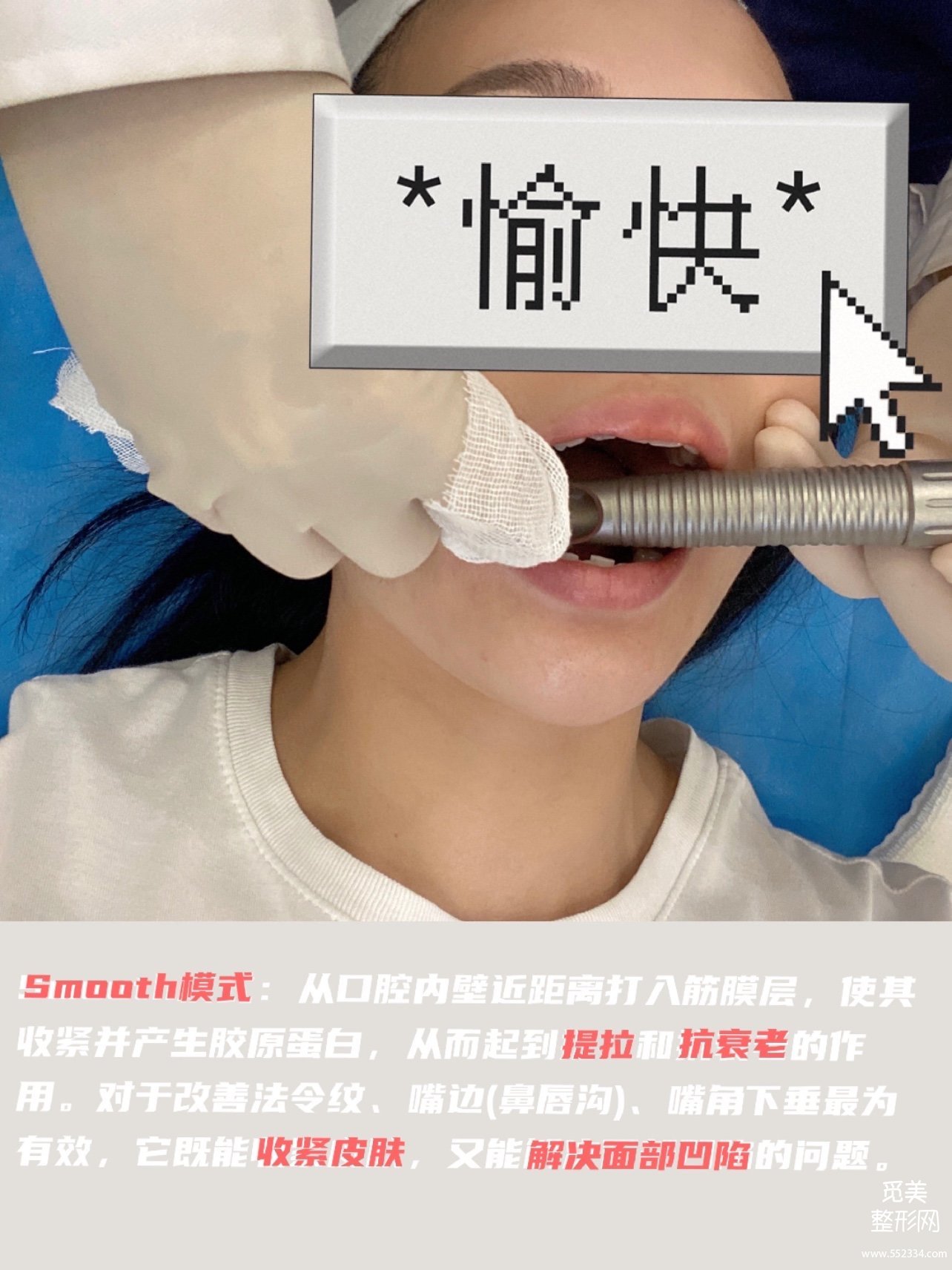 fotona 4d和热玛吉有区别吗?Fotona 4D Pro有没有副作用?案例解析